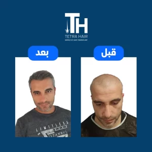صور حالة صلع كلى قبل وبعد العملية فى مركز تيترا هير لزراعة الشعر