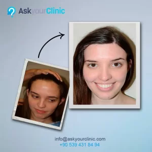 فتاة تعانى من صلع قبل وبعد إجراء عملية زراعة الشعر في مركز Ask Your Clinic