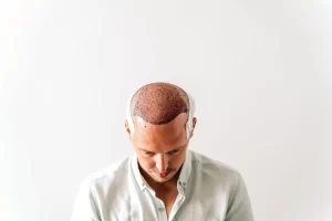 بعد زراعة الشعر بالشرائح (FUT) - الشبكة العربية لزراعة الشعر