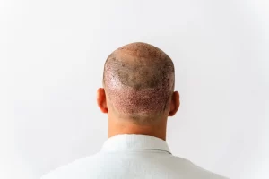 بعد زراعة الشعر بالفصل الوحيد (FUE) - الشبكة العربية لزراعة الشعر