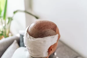 راس رجل من الخلف بعد زراعة الشعر بالشرائح (FUT) - الشبكة العربية لزراعة الشعر