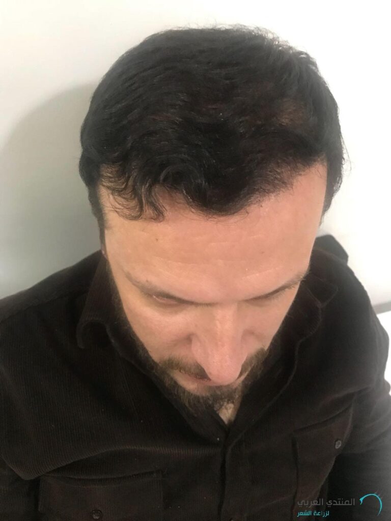 تجربة المساعد أبو زيد بعد إجراء زراعة الشعر