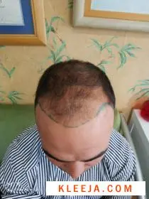تجربتي لزراعة الشعر في مركز رويال هير بلاس بعد تحديد رسم الجبهة