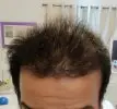 رأس رجل يعانى من الصلع بعد عملية زراعة الشعر بسبعة أشهر وتجربتي في زراعة الشعر لدى رويال