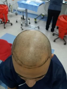 رأس رجل يعانى من الصلع قبل عملية زراعة الشعر مباشرة وتجربتي في زراعة الشعر لدى رويال
