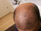 رأس رجل يعانى من الصلع قبل عملية زراعة الشعر وتجربتي في زراعة الشعر لدى رويال