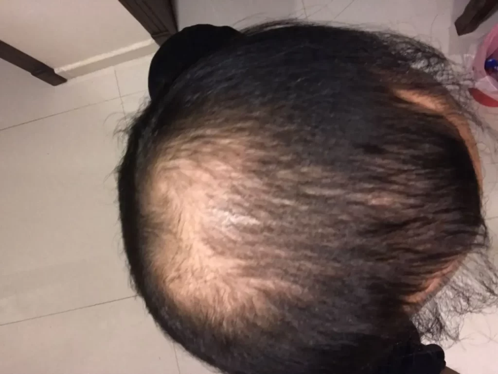 رأس مريض قبل زراعة الشعر فى تركيا وتجربتي في مركز رويال هير بلاس