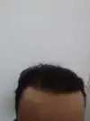 رأس مريض يعاني من الصلع بعد زراعة الشعر في تركيا
