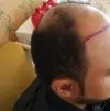 رأس مريض يعاني من الصلع قبل زراعة الشعر في تركيا