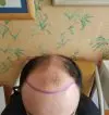 رأس مريض يعاني من انحسار خط الشعر قبل زراعة الشعر في تركيا