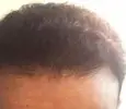 راس رجل بعد زراعة الشعر و تجربتي عند الدكتور بسام جباعي