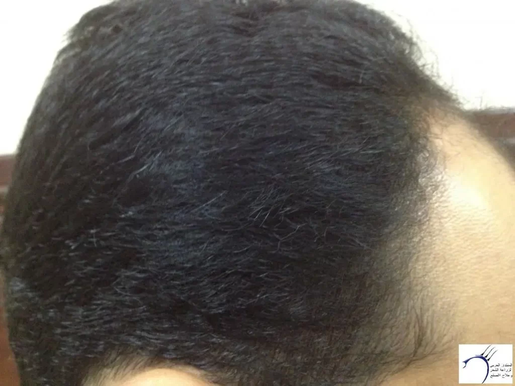 راس رجل قبل زراعة الشعر و تجربتي عند الدكتور بسام جباعي