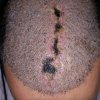 النخر بعد زراعة الشعر  Necrosis الآثار الجانبية لزراعة الشعر.jpg